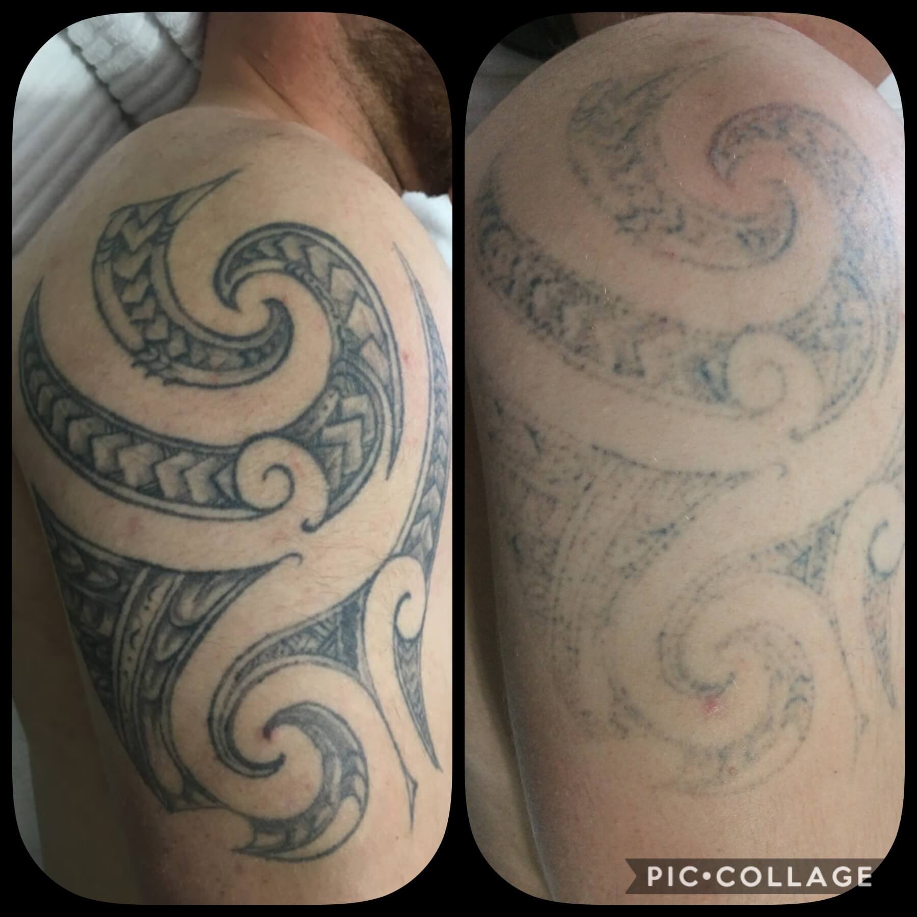 Laser tattoo removal before after perth