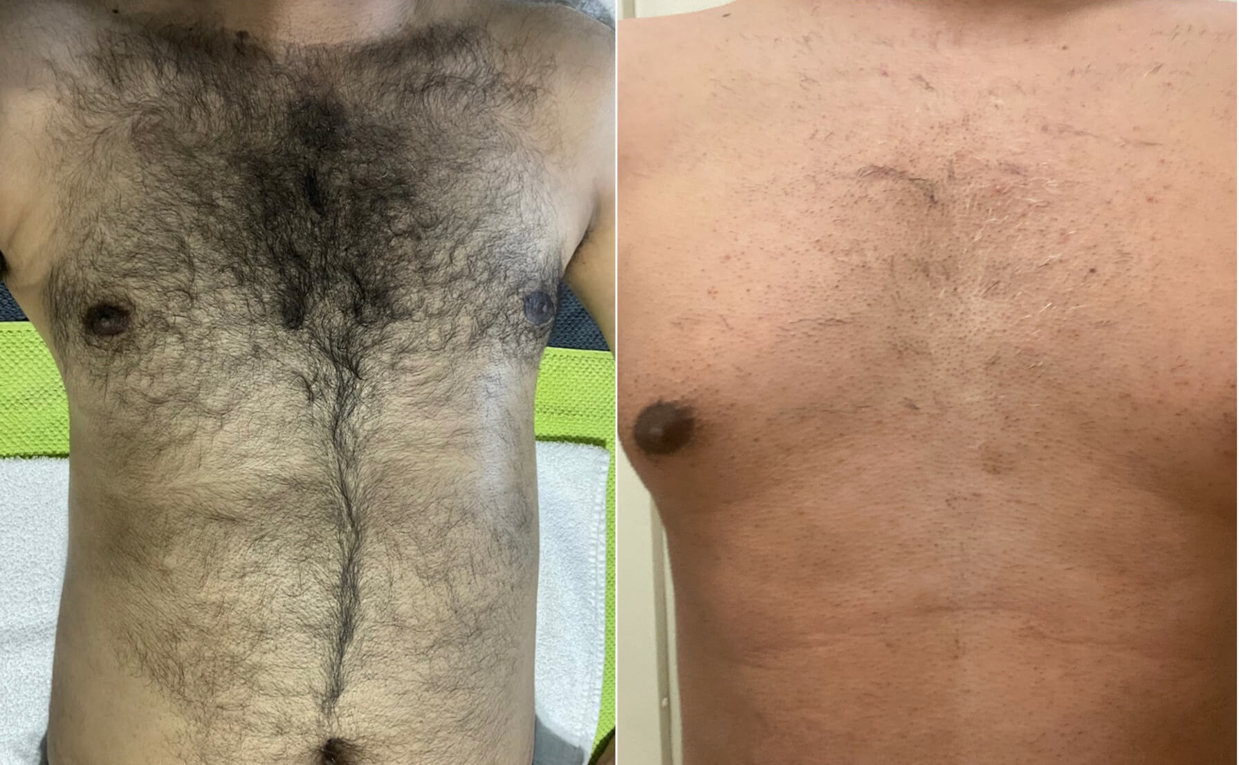 mens permanent chest hair removal perth