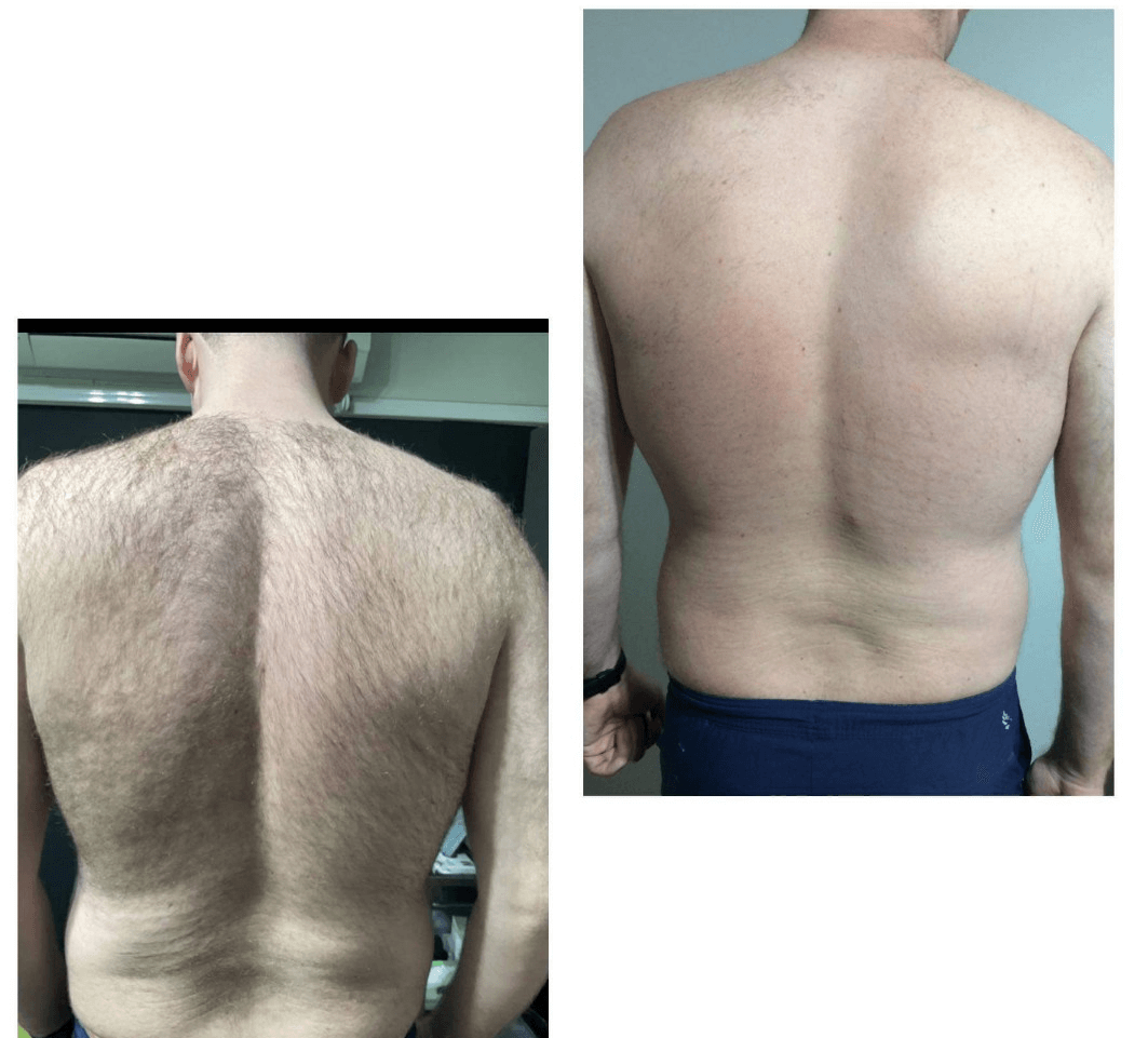 IPL Back Hair Removal Results Perth