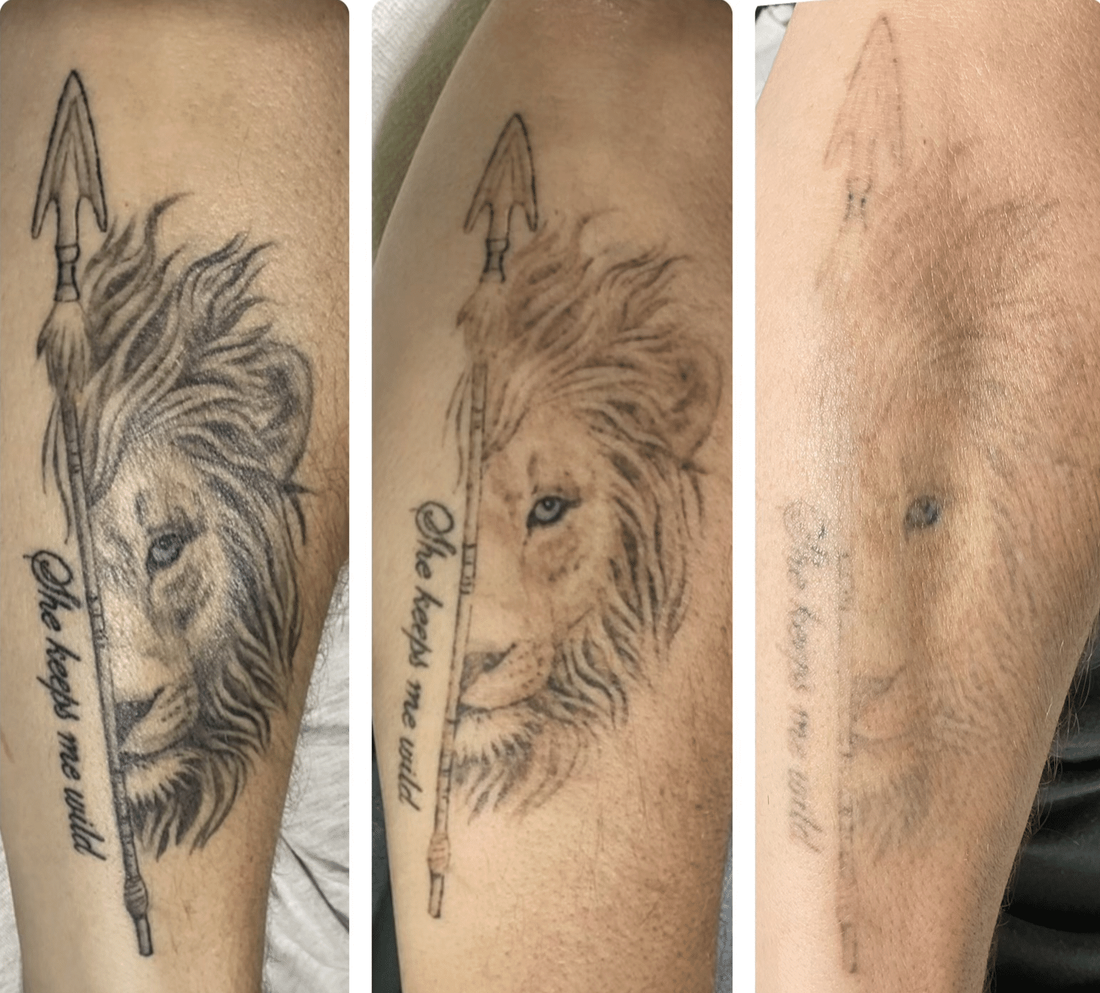 Leg Tattoo Removal Perth